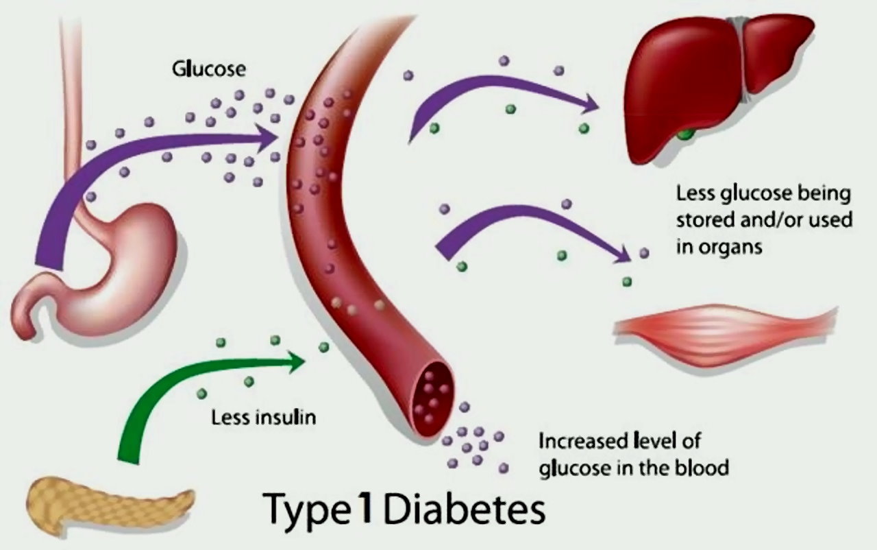 Diabete, Panebianco: "La patologia di tipo 1 si può sconfiggere con la prevenzione"