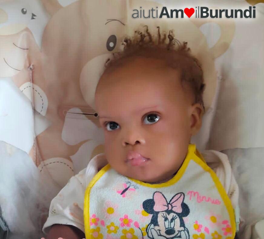 Taormina, altra bimba del Burundi operata e dimessa
