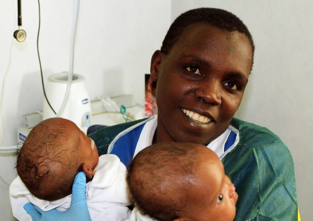 Separate a Roma gemelle siamesi arrivate dal Burundi