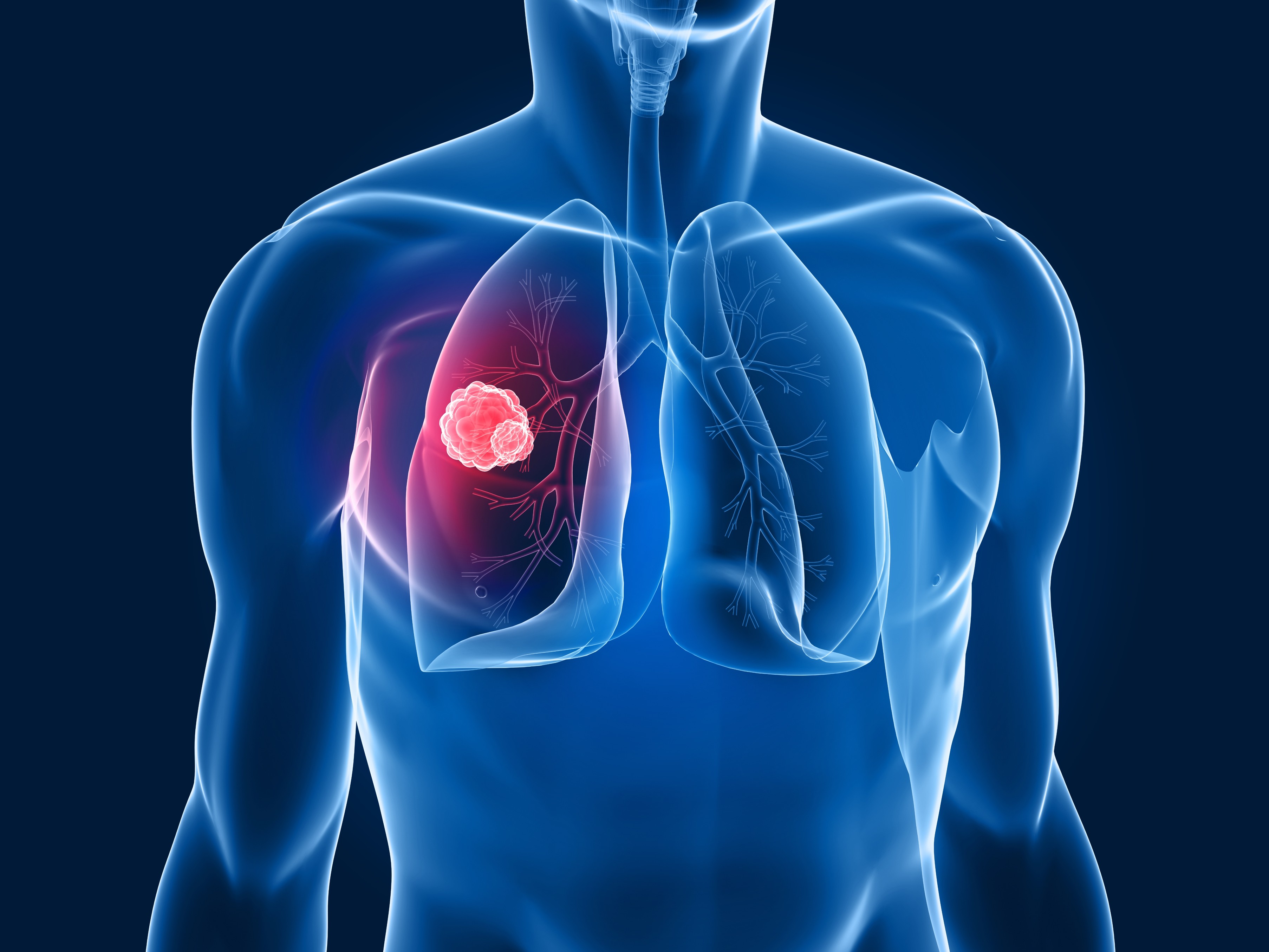 Tumori: in Italia nuova immunoterapia contro il cancro al polmone 